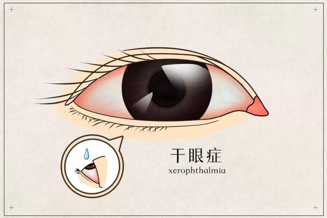 幹眼患者福音(yīn)來(lái)啦！(圖2)